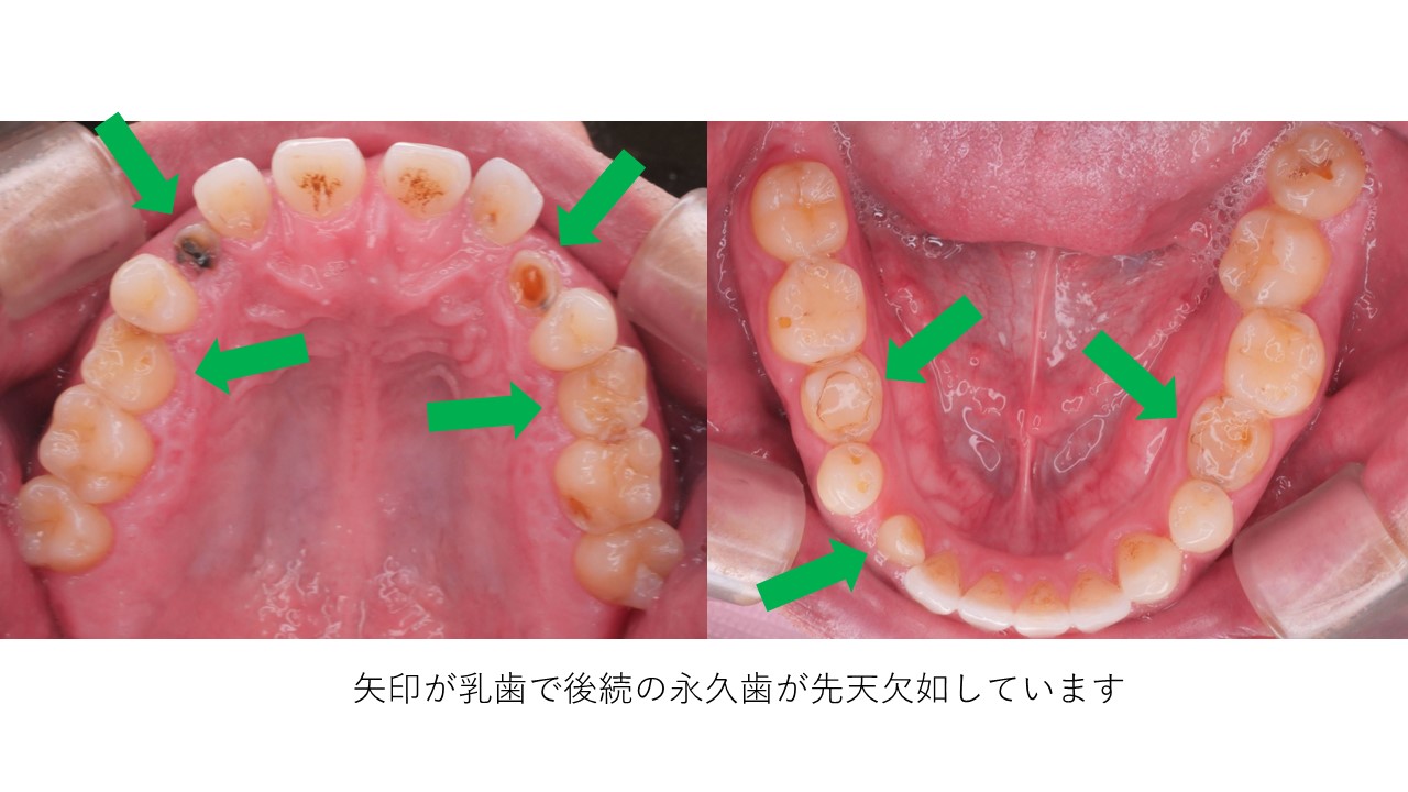 乳歯から永久歯に生えかわらないなと思ったら・・・