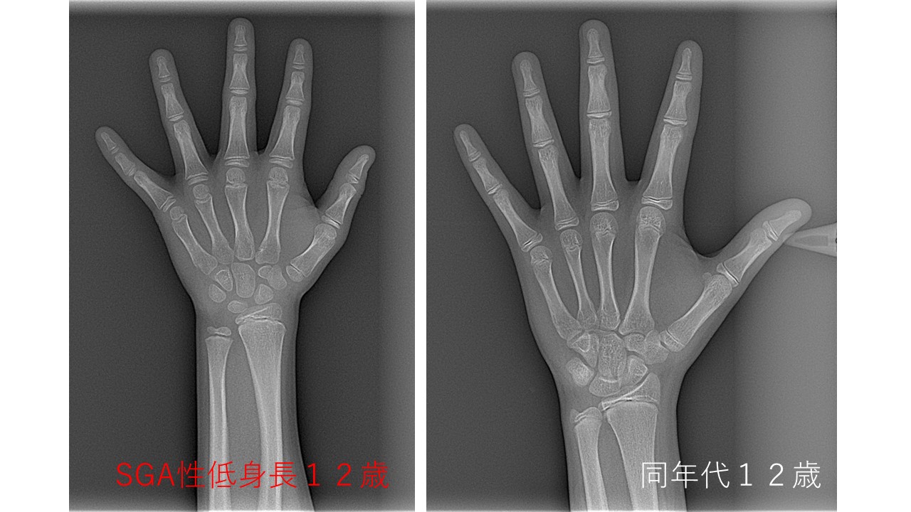成長障害に関する矯正治療について（SGA性低身長症）