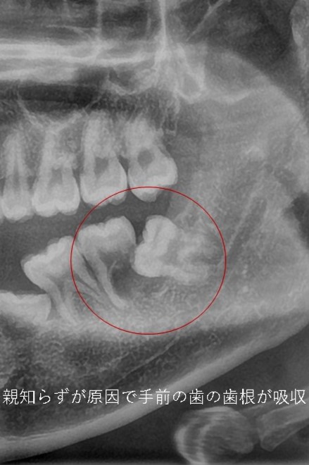 親知らずは歯並びに影響するか？親知らずは抜歯が必要か？