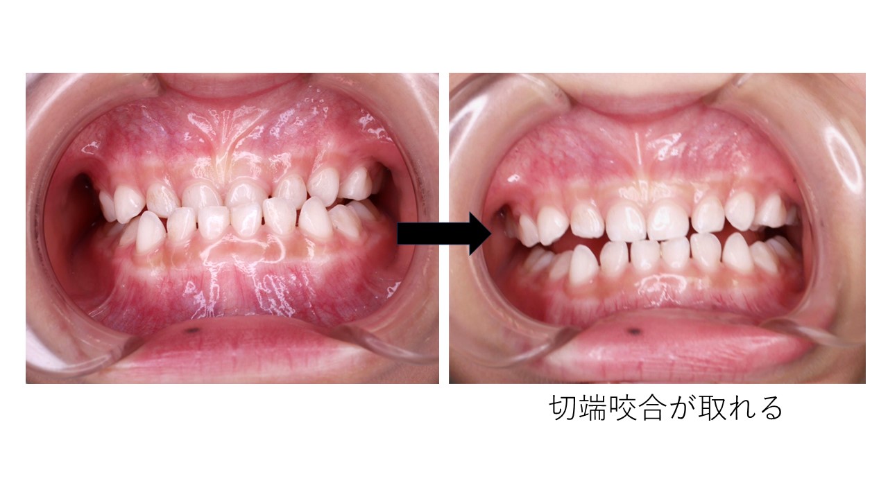 反対咬合（受け口）は自力で治すことができるでしょうか？