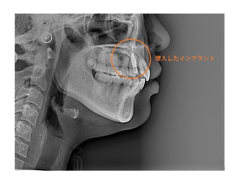 インプラント補綴治療と矯正治療の関係