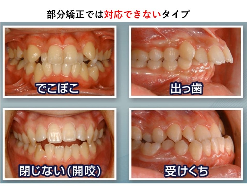 部分矯正はどんな場合に対応できますか？